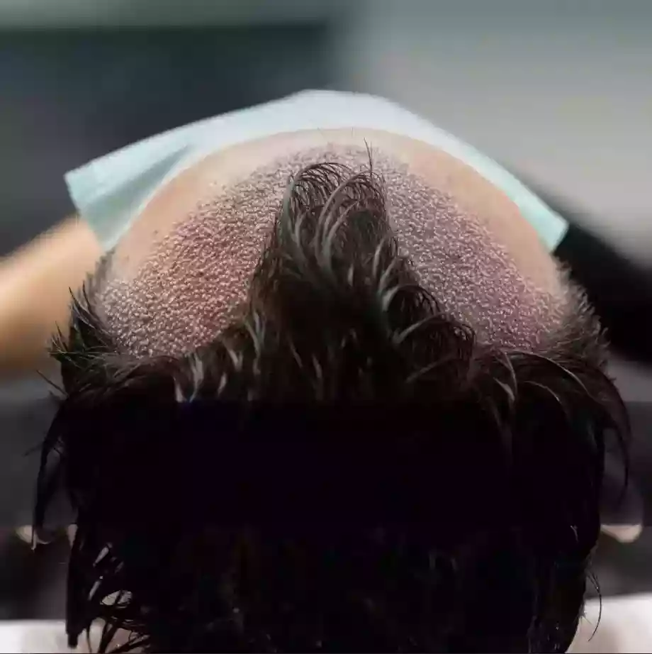 DHI Hair Transplant Antalya Turkey procedure day planning