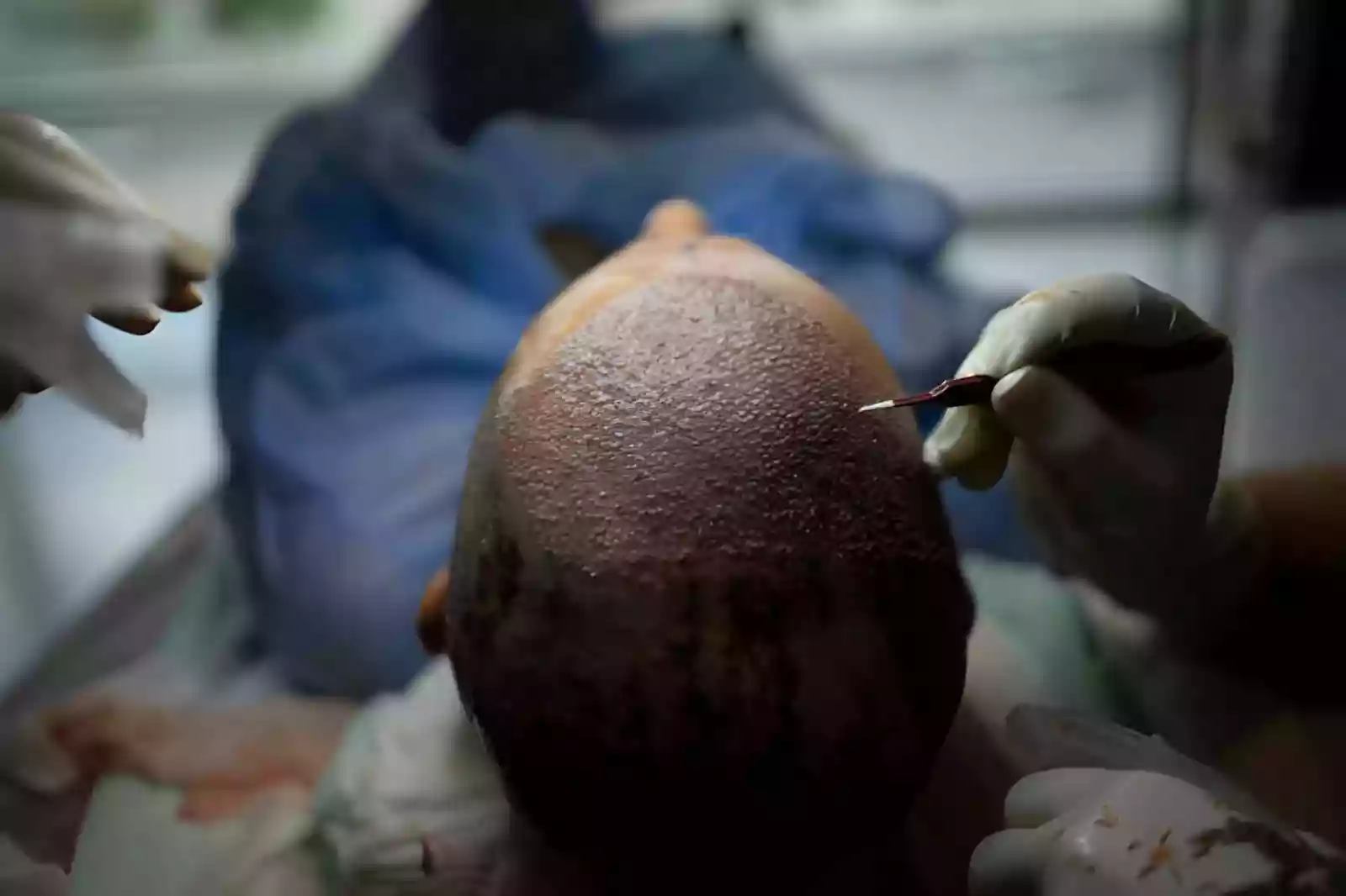 Hair Transplant Antalya Turkey choosing a treatment provider
