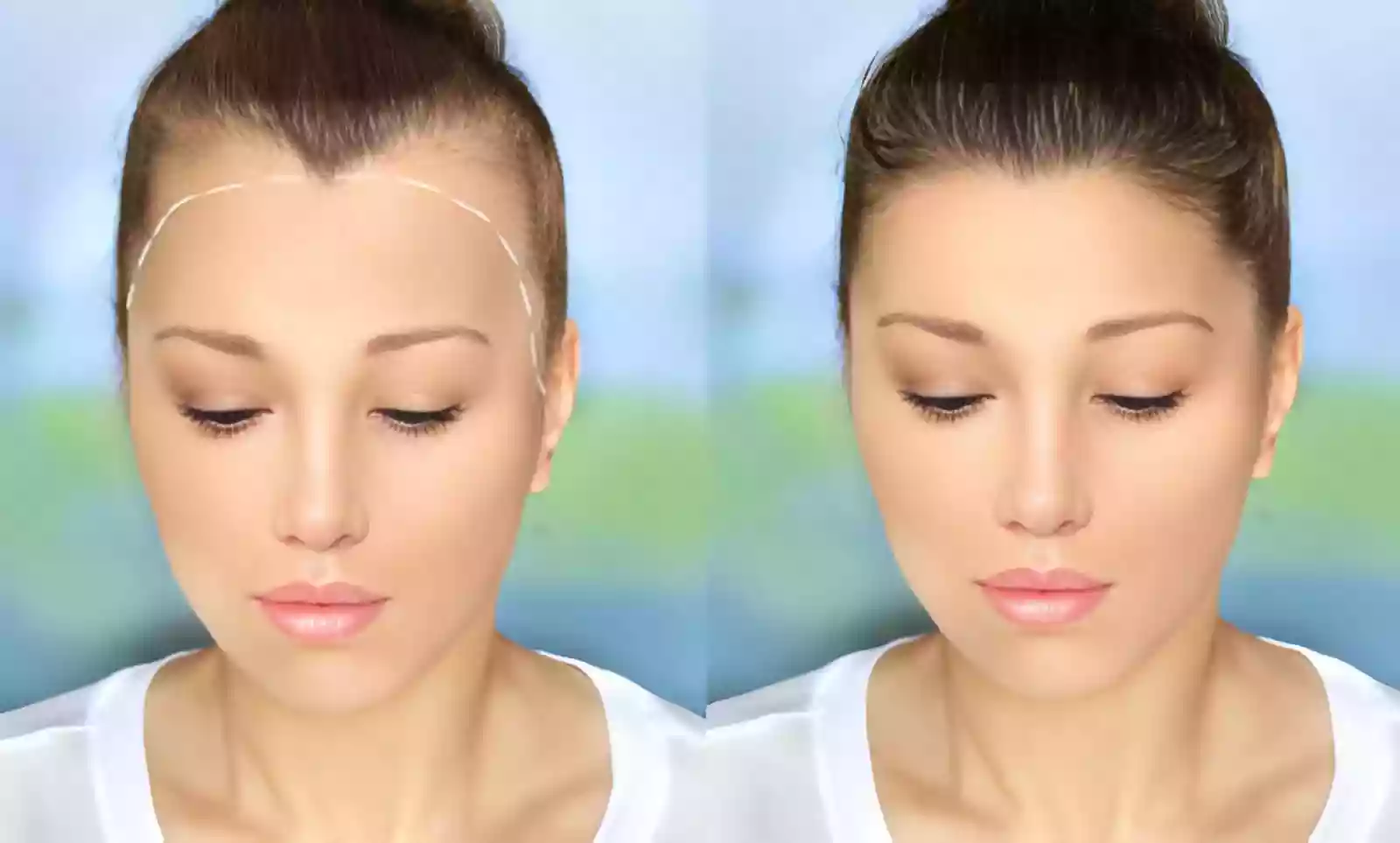 Hair Transplant Antalya Turkey hair restoration planning