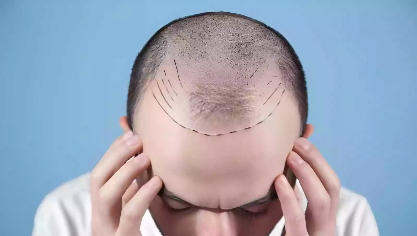 Hair Transplant Antalya Turkey donor area planning